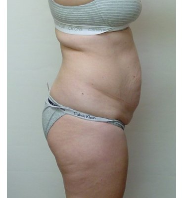 abdominoplasty side view before